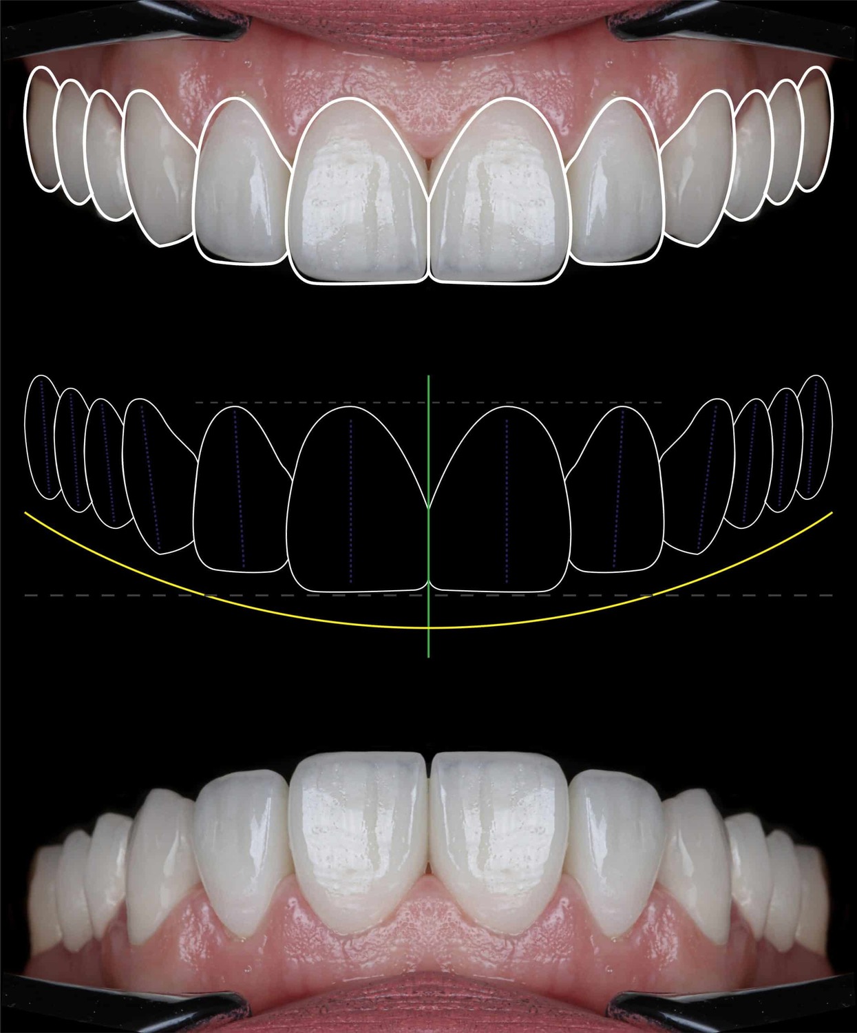 <span style="font-weight: bold;">Diseño de Sonrisa</span>&nbsp;