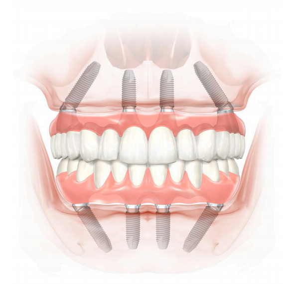 <span style="font-weight: bold;">Dentadura sobre Implantes</span>&nbsp;
