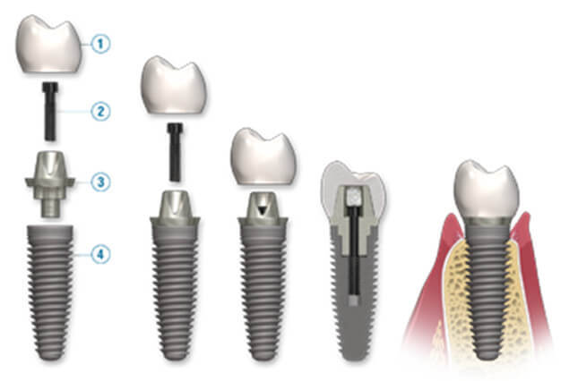 <span style="font-weight: bold;">Implante Dental</span>&nbsp;