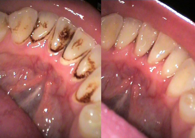 <span style="font-weight: bold;">Limpieza Dental Ultrasonica</span>&nbsp;